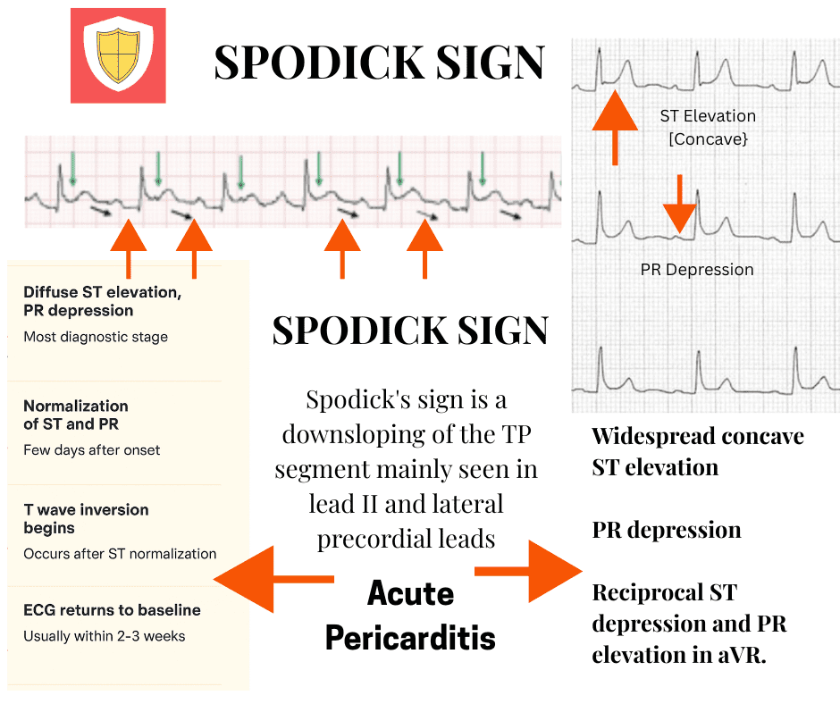 ECG in acute pericarditis,,PR depression ECG,,Pericarditis vs STEMI,,ST elevation concave,,ECG stages of pericarditis,,ST/T ratio in V6,,T wave inversion pericarditis,,PR elevation in aVR