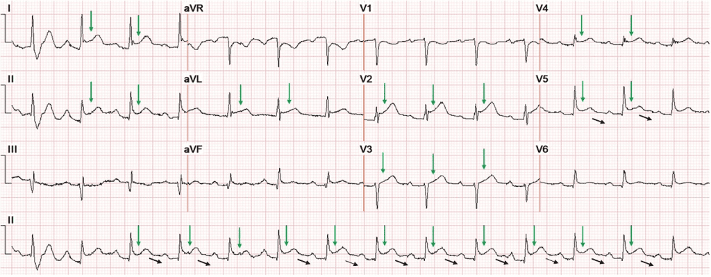ECG in acute pericarditis,,PR depression ECG,,Pericarditis vs STEMI,,ST elevation concave,,ECG stages of pericarditis,,ST/T ratio in V6,,T wave inversion pericarditis,,PR elevation in aVR