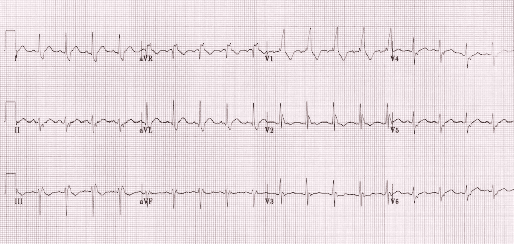 bifascicular block