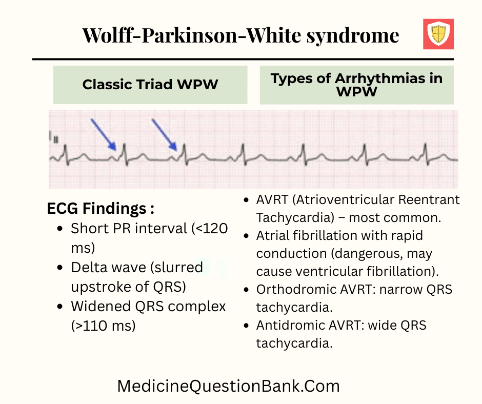 WPW Syndrome