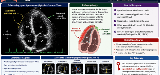 McConnell's Sign Echocardiography Guide